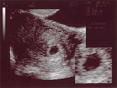 胎児のエコー写真