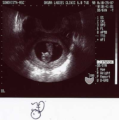 胎児のエコー写真